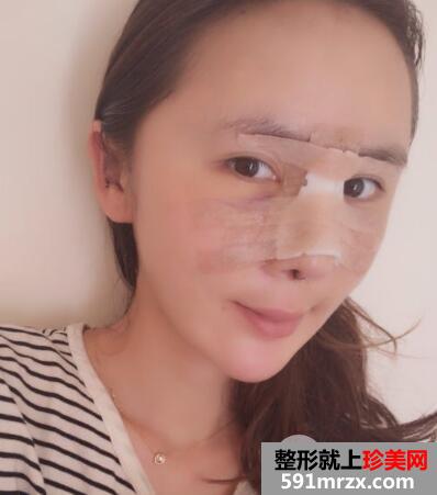 做了全脸脂肪填充效果很好一个月恢复自然真实案例对比图