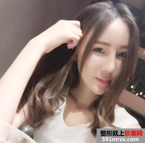 做了全脸脂肪填充效果很好一个月恢复自然真实案例对比图