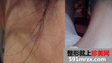 全身激光脱毛三次价格贵但据说脱毛效果永久