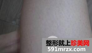 全身激光脱毛三次价格贵但据说脱毛效果永久