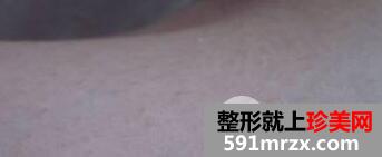 全身激光脱毛三次价格贵但据说脱毛效果永久