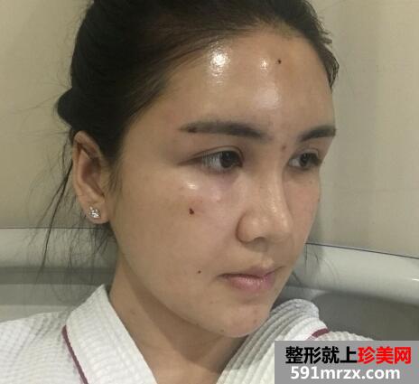 自体脂肪面部填充价格贵但效果好15天恢复过程图
