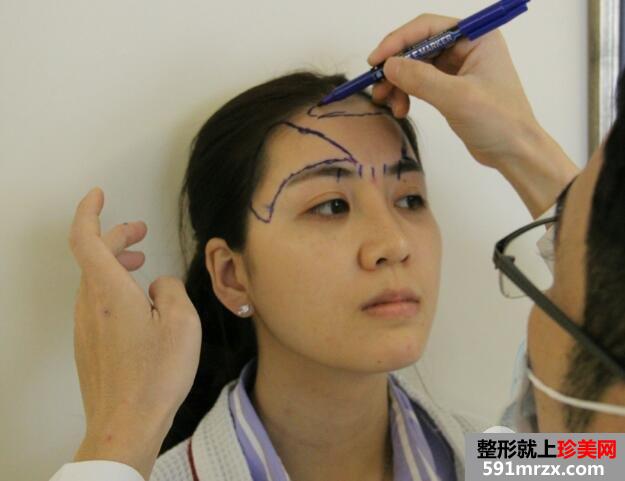 自体脂肪面部填充价格贵但效果好15天恢复过程图