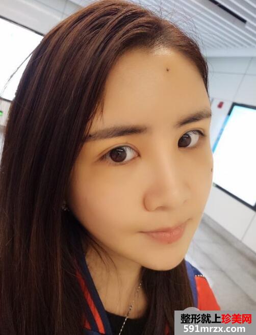 自体脂肪面部填充价格贵但效果好15天恢复过程图