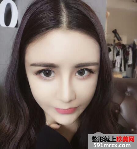 自体脂肪面部填充价格贵但效果好15天恢复过程图