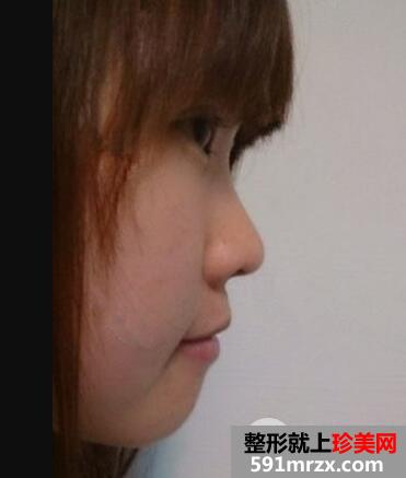 鼻子整形选择的是瑞蓝玻尿酸隆鼻价格略贵但效果好