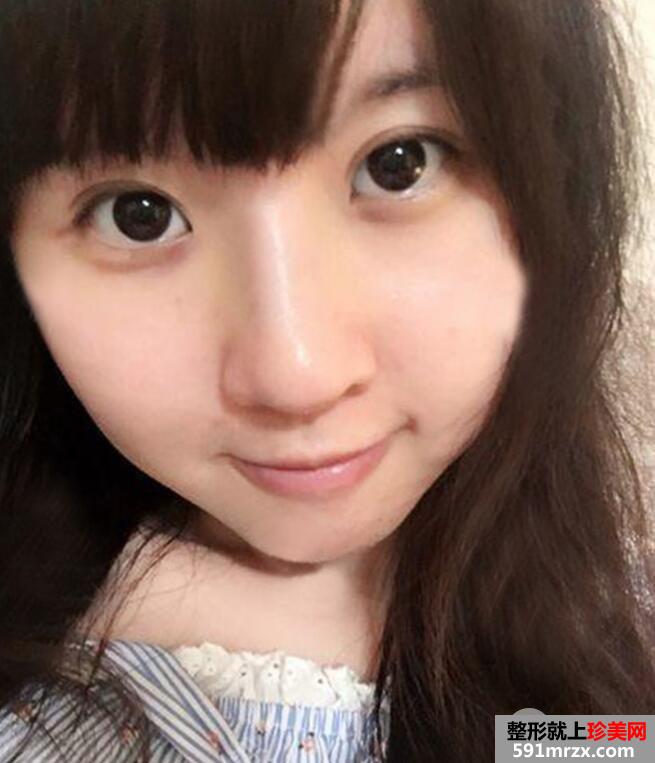 鼻子整形选择的是瑞蓝玻尿酸隆鼻价格略贵但效果好