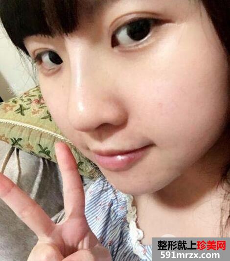 鼻子整形选择的是瑞蓝玻尿酸隆鼻价格略贵但效果好