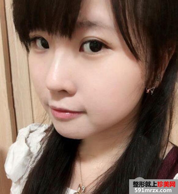 鼻子整形选择的是瑞蓝玻尿酸隆鼻价格略贵但效果好