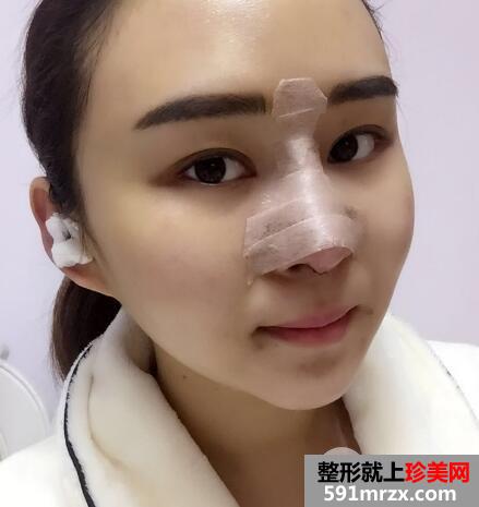 做了假体隆鼻和垫鼻尖的鼻综合鼻子整形恢复过程图