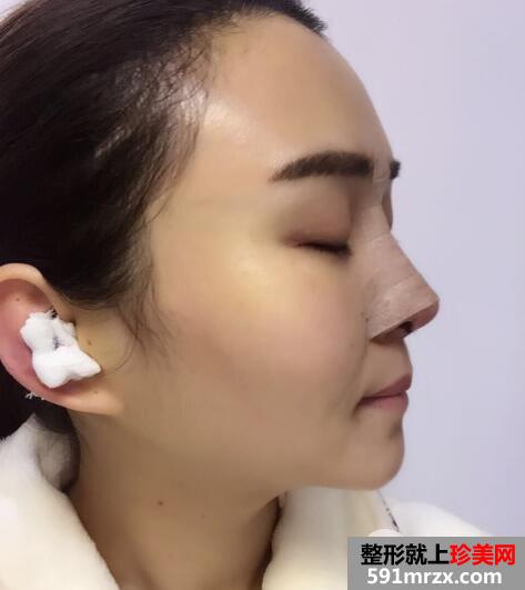 做了假体隆鼻和垫鼻尖的鼻综合鼻子整形恢复过程图