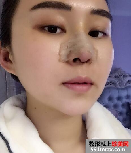 做了假体隆鼻和垫鼻尖的鼻综合鼻子整形恢复过程图