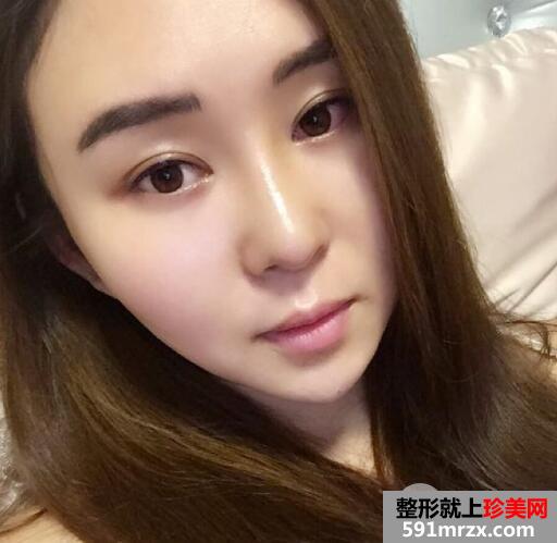 做了假体隆鼻和垫鼻尖的鼻综合鼻子整形恢复过程图