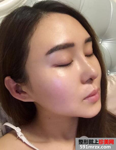做了假体隆鼻和垫鼻尖的鼻综合鼻子整形恢复过程图
