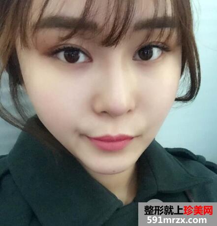 做了假体隆鼻和垫鼻尖的鼻综合鼻子整形恢复过程图
