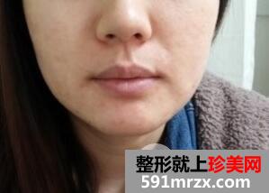 瑞蓝玻尿酸丰唇多少钱？一支玻尿酸丰嘟嘟唇效果图真实案例