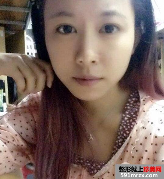 保妥适瘦脸针多少钱?注射瘦脸针一个月案例效果图