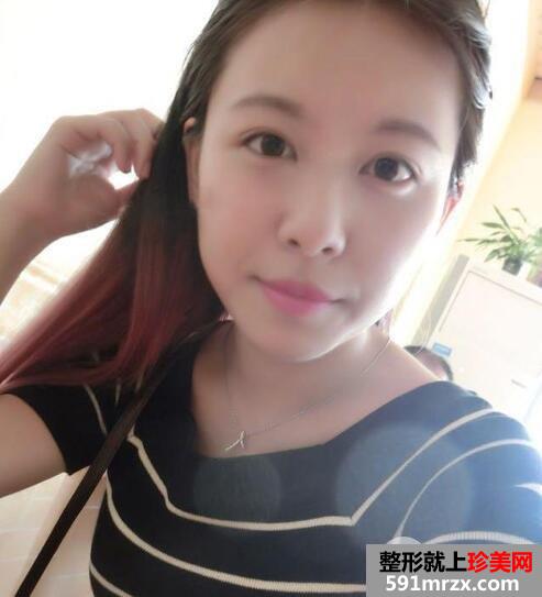 保妥适瘦脸针多少钱?注射瘦脸针一个月案例效果图