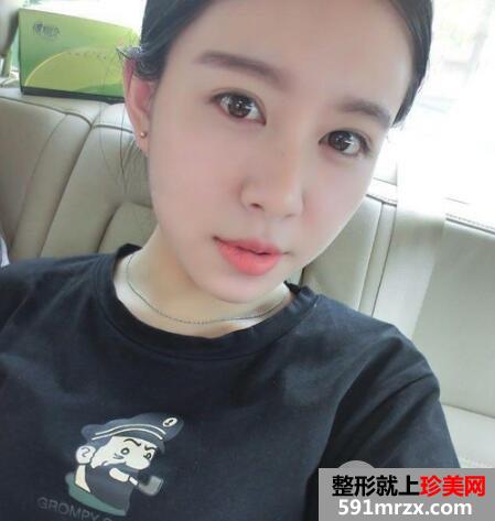 保妥适瘦脸针多少钱?注射瘦脸针一个月案例效果图
