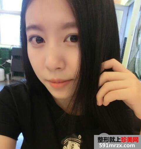 保妥适瘦脸针多少钱?注射瘦脸针一个月案例效果图