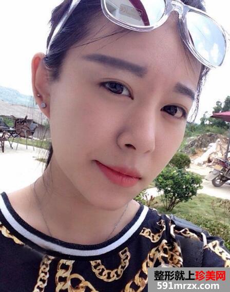 保妥适瘦脸针多少钱?注射瘦脸针一个月案例效果图