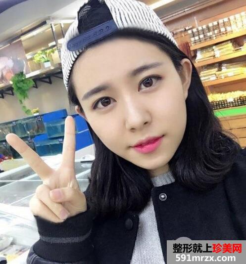 保妥适瘦脸针多少钱?注射瘦脸针一个月案例效果图