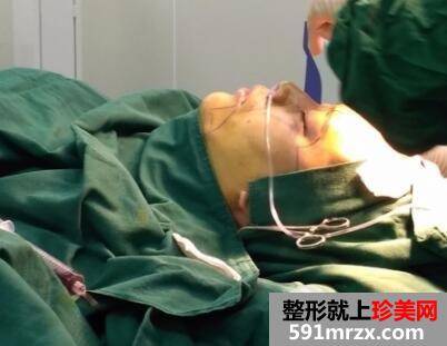 全脸脂肪填充刚做完图感觉好丑几天消肿后效果很好真实案例