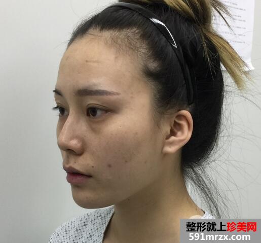全脸脂肪填充刚做完图感觉好丑几天消肿后效果很好真实案例