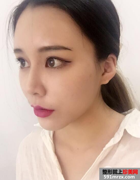 全脸脂肪填充刚做完图感觉好丑几天消肿后效果很好真实案例