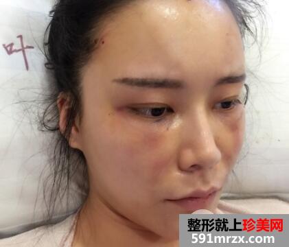 全脸脂肪填充刚做完图感觉好丑几天消肿后效果很好真实案例