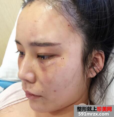 全脸脂肪填充刚做完图感觉好丑几天消肿后效果很好真实案例
