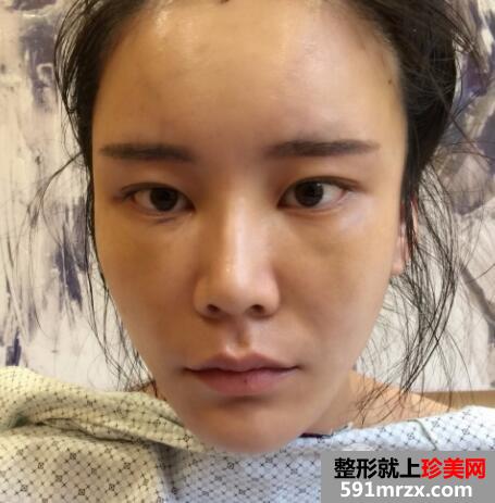 全脸脂肪填充刚做完图感觉好丑几天消肿后效果很好真实案例