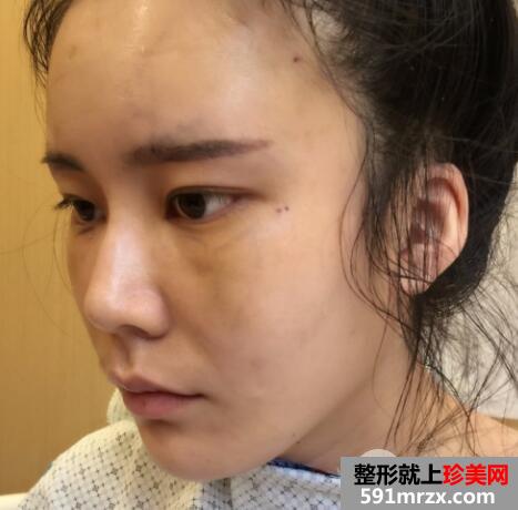 全脸脂肪填充刚做完图感觉好丑几天消肿后效果很好真实案例