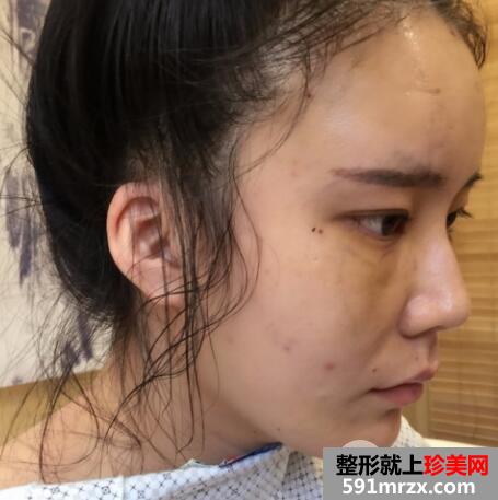 全脸脂肪填充刚做完图感觉好丑几天消肿后效果很好真实案例