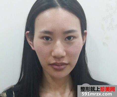 北京清木整形做的自体脂肪丰太阳穴价格和照片案例