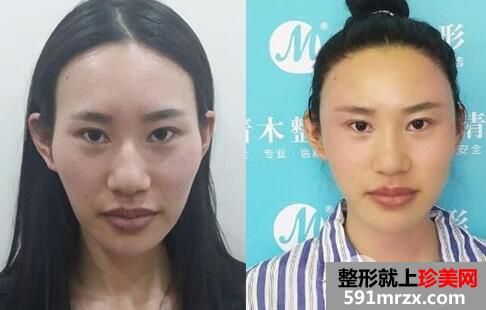 北京清木整形做的自体脂肪丰太阳穴价格和照片案例
