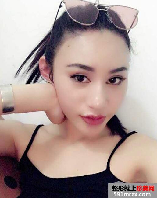 北京清木整形做的自体脂肪丰太阳穴价格和照片案例