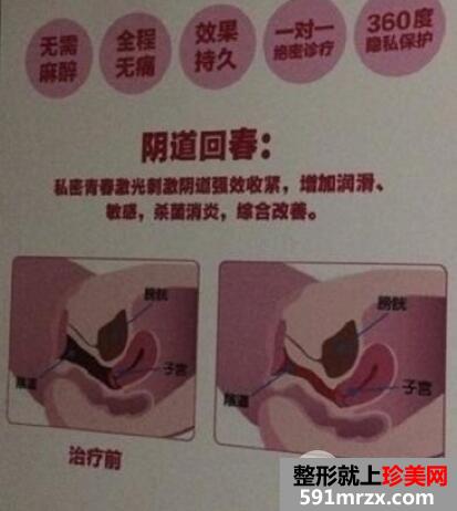 在美联臣整形医院做的女性私密整形阴道紧缩手术价格和案例