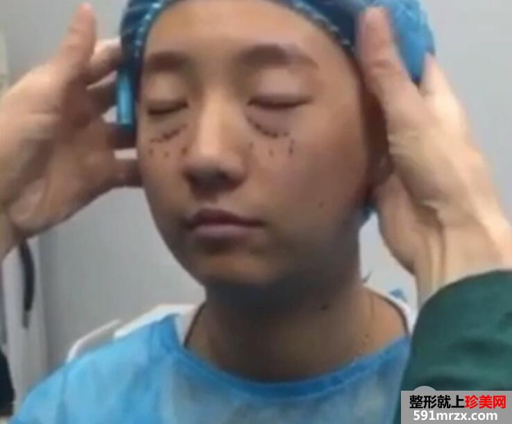 超声波法去眼袋价格略贵但效果好 手术后六天照片真实案例