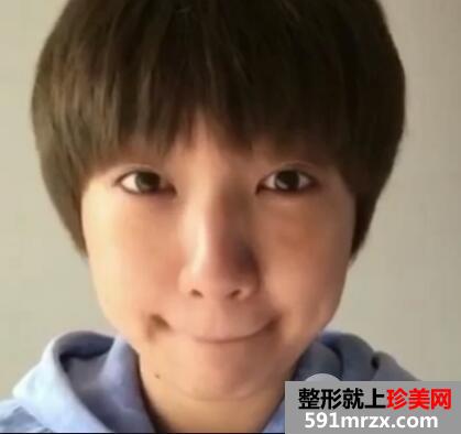 超声波法去眼袋价格略贵但效果好 手术后六天照片真实案例