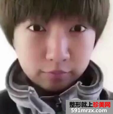 超声波法去眼袋价格略贵但效果好 手术后六天照片真实案例