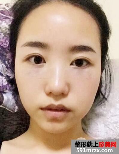 北京丽都做的超声波去眼袋价格适宜效果好 手术后六天照片