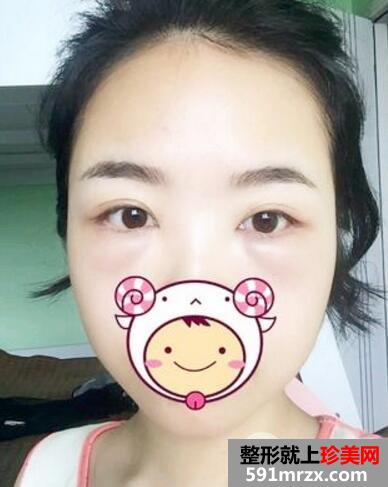 北京丽都做的超声波去眼袋价格适宜效果好 手术后六天照片