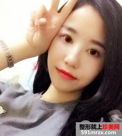 北京丽都做的超声波去眼袋手术后六天照片 价格适宜效果好