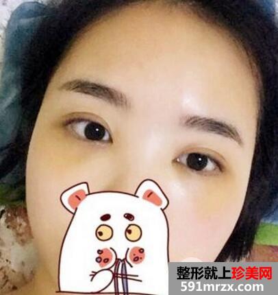 北京丽都做的超声波去眼袋手术后六天照片 价格适宜效果好