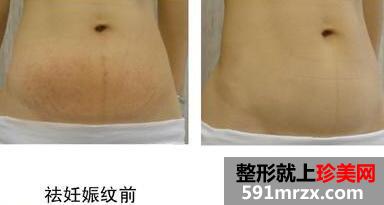 去妊娠纹价格效果图片方法【全面介绍】