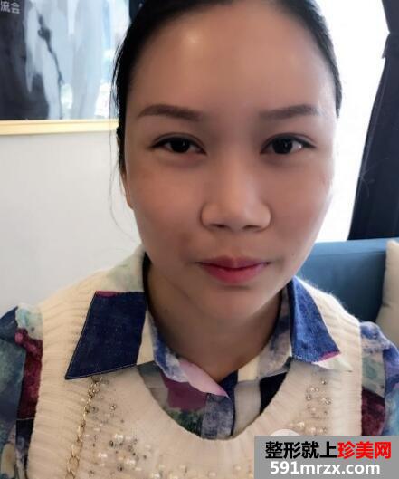 又去时光整形医院做了自体隆鼻 价格和恢复效果图