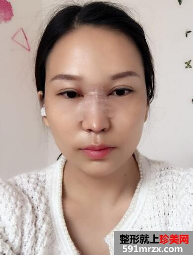 又去时光整形医院做了自体隆鼻 价格和恢复效果图