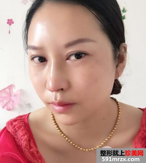 又去时光整形医院做了自体隆鼻 价格和恢复效果图