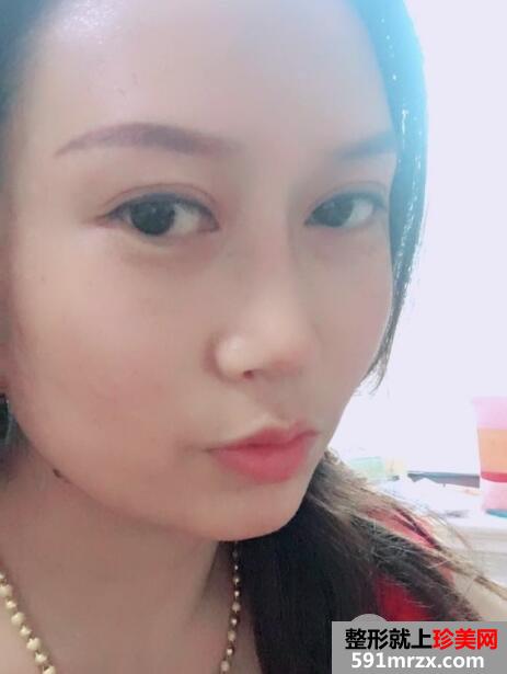 又去时光整形医院做了自体隆鼻 价格和恢复效果图